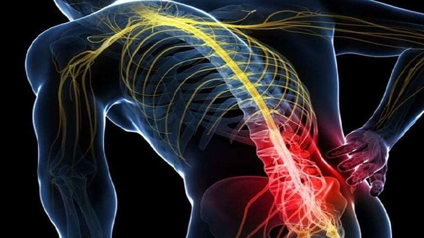 Sciatica
